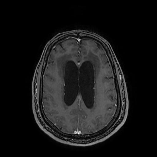 Cerebellar hemangioblastoma (Radiopaedia 88055-104622 Axial T1 C+ 122).jpg