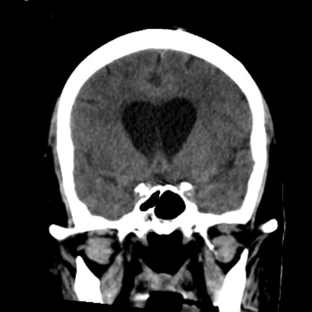 Cerebellar hemorrhage causing obstructive hydrocephalus (Radiopaedia 33989-35207 Coronal non-contrast 22).jpg