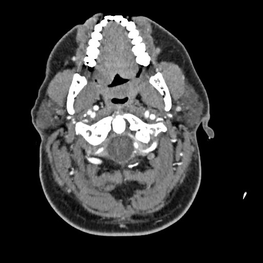 Cerebellar infarct due to vertebral artery dissection with posterior fossa decompression (Radiopaedia 82779-97029 C 60).png
