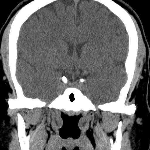 Cerebellar infarction (Radiopaedia 16625-16327 Coronal non-contrast 1).jpg