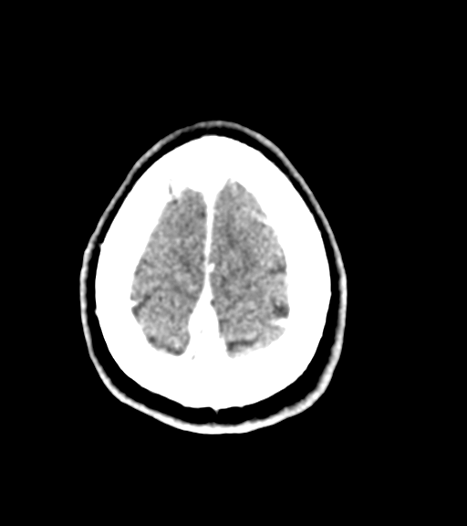 Cerebellar metastases - colorectal adenocarcinoma (Radiopaedia 40947-43652 Axial C+ 59).png