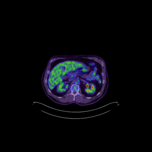 Cerebellar metastasis (Radiopaedia 33616-34719 A 87).png