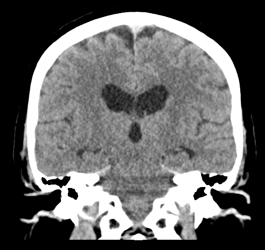 Cerebellar metastasis (Radiopaedia 54578-60812 Coronal non-contrast 32).png