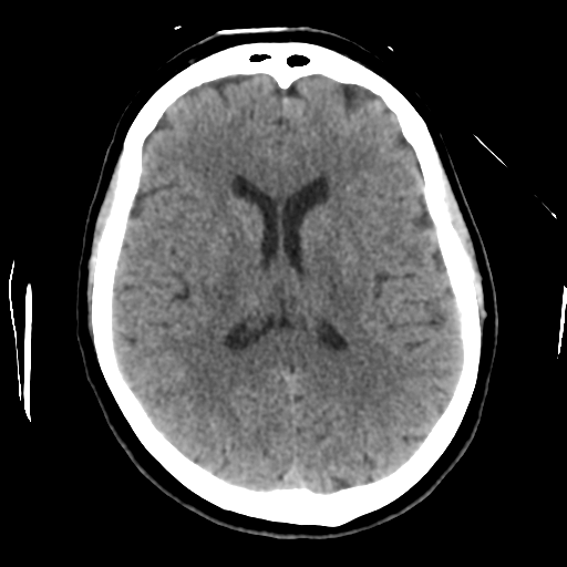 Cerebellar metastasis (cystic appearance) (Radiopaedia 41395-44258 Axial non-contrast 31).png