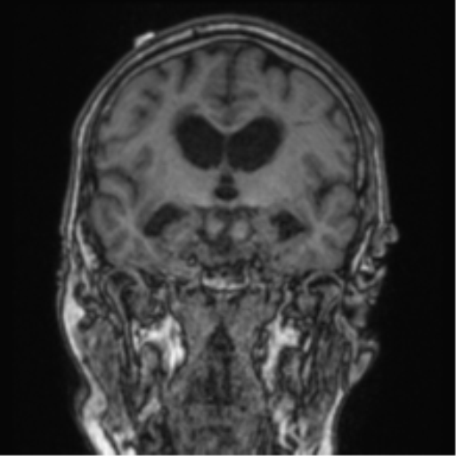 Cerebellar metastasis from lung adenocarcinoma (Radiopaedia 86690-102829 Coronal T1 56).png