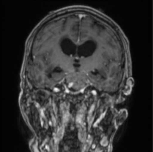 File:Cerebellar metastasis from lung adenocarcinoma (Radiopaedia 86690-102829 Coronal T1 C+ 53).png