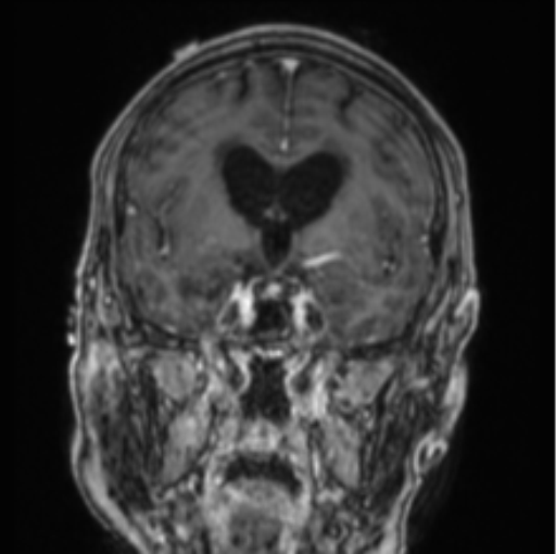 Cerebellar metastasis from lung adenocarcinoma (Radiopaedia 86690-102829 Coronal T1 C+ 59).png