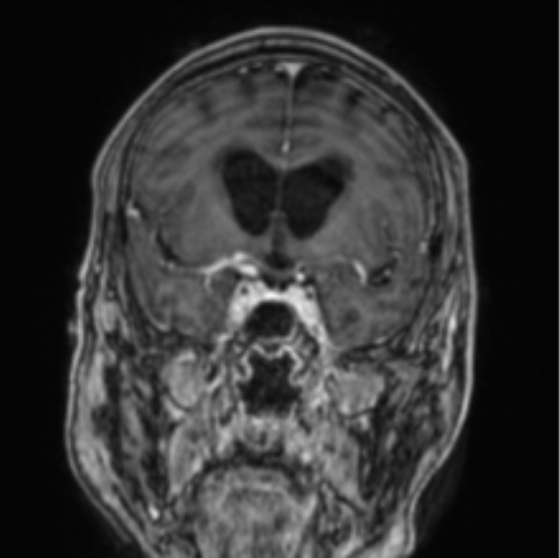 Cerebellar metastasis from lung adenocarcinoma (Radiopaedia 86690-102829 Coronal T1 C+ 62).png