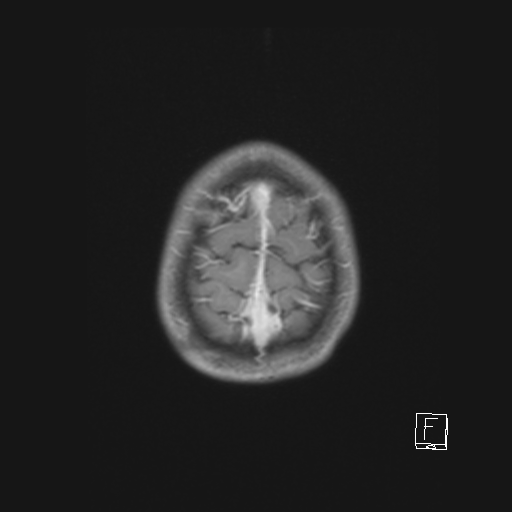 Cerebellar stroke (Radiopaedia 32202-33150 Axial T1 C+ 62).png
