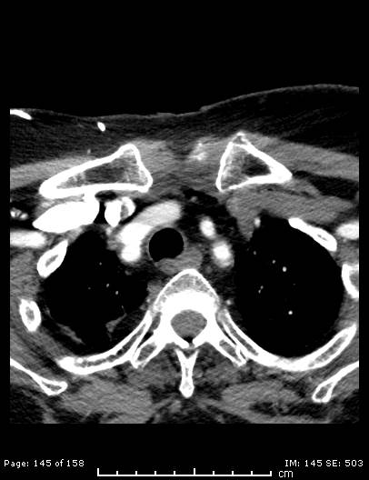 Cerebellar strokes due to intracranial giant cell arteritis (Radiopaedia 68799-78510 CT angiogram 145).jpg