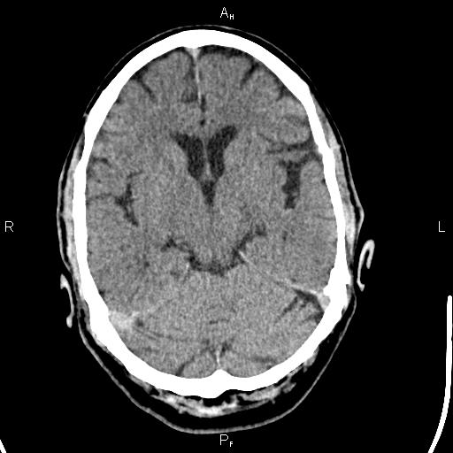 File:Cerebellopontine angle arachnoid cyst (Radiopaedia 85149-100704 Axial With contrast 20).jpg