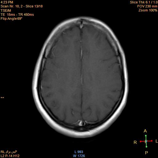 File:Cerebellopontine angle meningioma (Radiopaedia 22488-22525 Axial T1 C+ 12).jpg