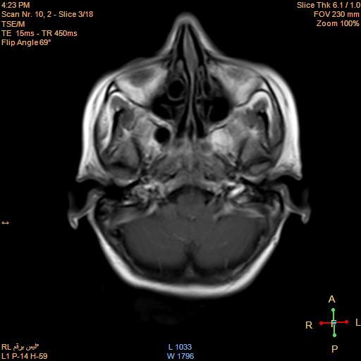 File:Cerebellopontine angle meningioma (Radiopaedia 22488-22525 Axial T1 C+ 2).jpg