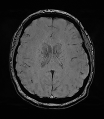 Cerebellopontine angle meningioma (Radiopaedia 48434-53348 Axial SWI 56).png
