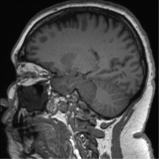 Cerebellopontine angle meningioma (Radiopaedia 48434-53348 Sagittal T1 37).png