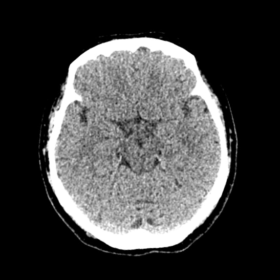 File:Cerebellopontine angle meningioma (Radiopaedia 53561-59592 Axial non-contrast 26).jpg