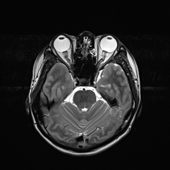 Cerebral abscess (Radiopaedia 24212-24478 Axial T2 23).jpg