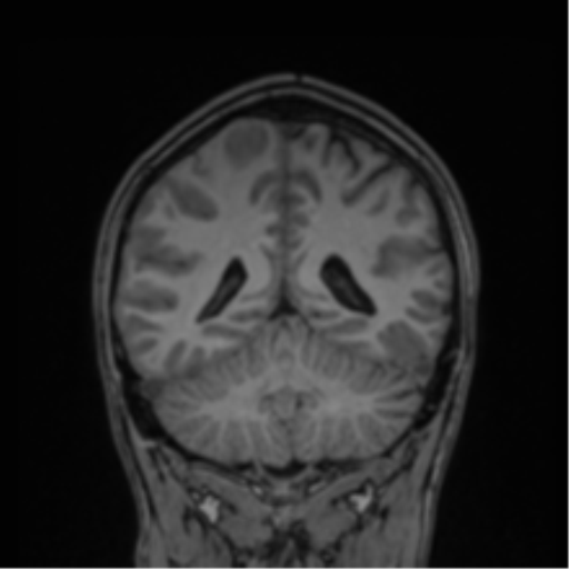 Cerebral abscess (Radiopaedia 60342-68009 Coronal T1 13).png