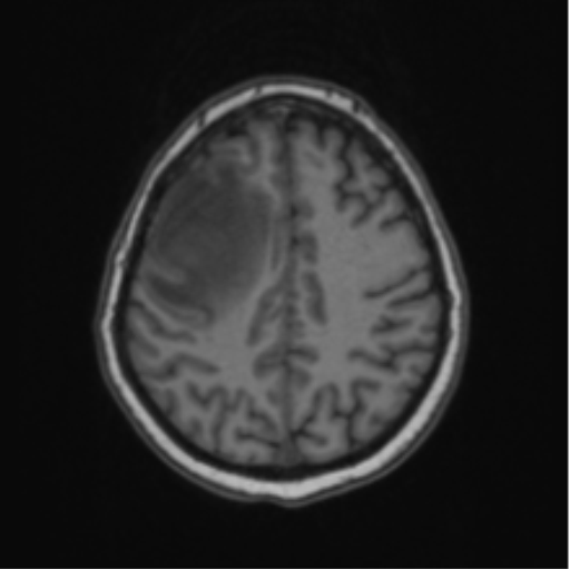 Cerebral abscess from pulmonary arteriovenous malformation (Radiopaedia 86275-102291 Axial T1 55).png