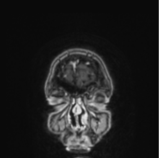 Cerebral abscess from pulmonary arteriovenous malformation (Radiopaedia 86275-102291 L 84).png
