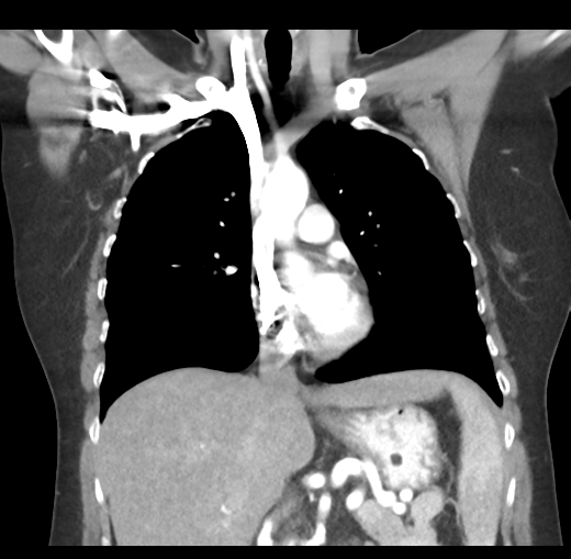 Cerebral abscess from pulmonary arteriovenous malformation (Radiopaedia 86275-102292 C 25).png