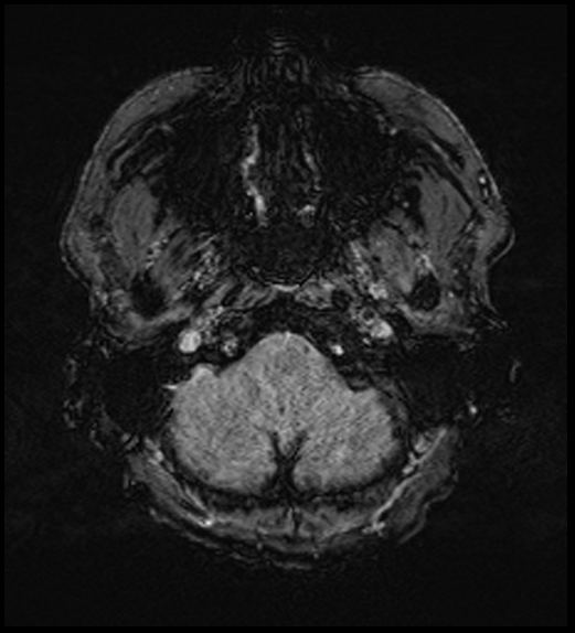 Cerebral abscess with ventriculitis (Radiopaedia 78965-91878 Axial SWI 8).jpg