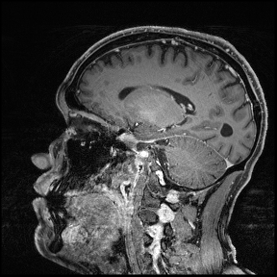 Cerebral abscess with ventriculitis (Radiopaedia 78965-91878 Sagittal T1 C+ 111).jpg