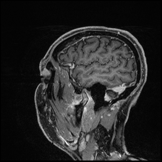 Cerebral abscess with ventriculitis (Radiopaedia 78965-91878 Sagittal T1 C+ 148).jpg