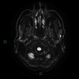 Cerebral amyloid angiopathy (Radiopaedia 77506-89664 Axial DWI 3).jpg
