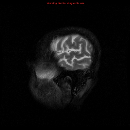File:Cerebral and orbital tuberculomas (Radiopaedia 13308-13311 Sagittal T2 1).jpg