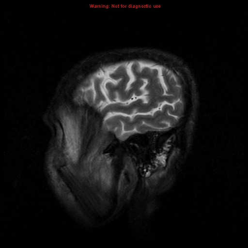 File:Cerebral and orbital tuberculomas (Radiopaedia 13308-13311 Sagittal T2 18).jpg