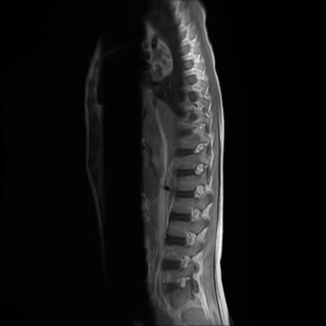 File:Cerebral and spinal tuberculosis (Radiopaedia 90489-107912 Sagittal T1 C+ 10).jpg