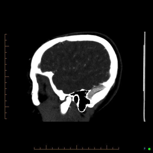 Cerebral arteriovenous malformation (AVM) (Radiopaedia 78162-90706 Sagittal CTA 65).jpg