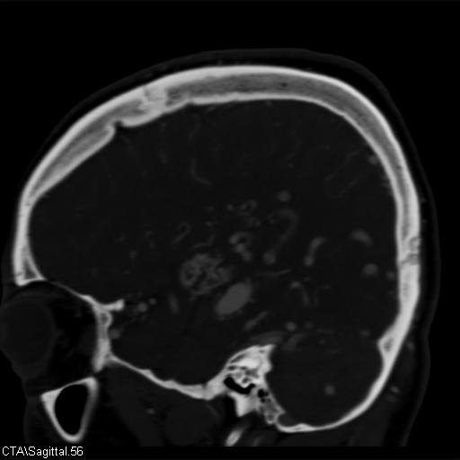 Cerebral arteriovenous malformation (Radiopaedia 28518-28759 D 53).jpg