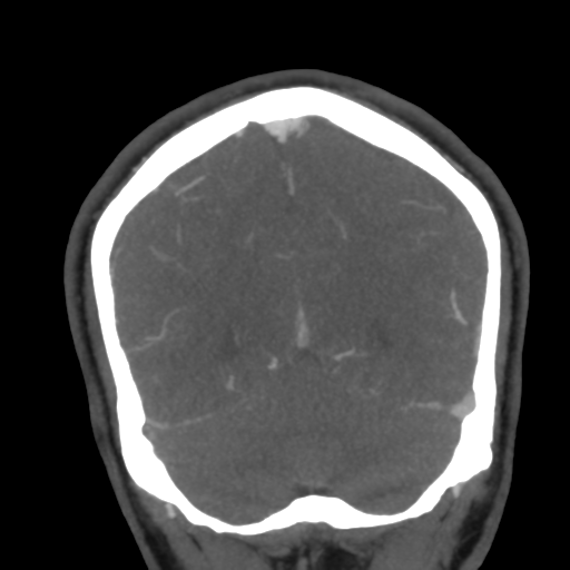 Cerebral arteriovenous malformation (Radiopaedia 39259-41505 E 52).png