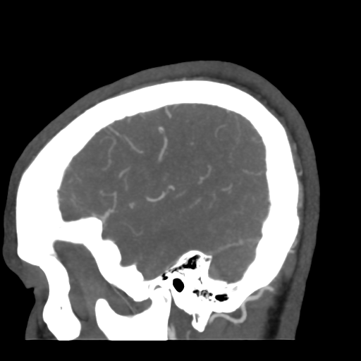 Cerebral arteriovenous malformation (Radiopaedia 39259-41505 Sagittal 12).png