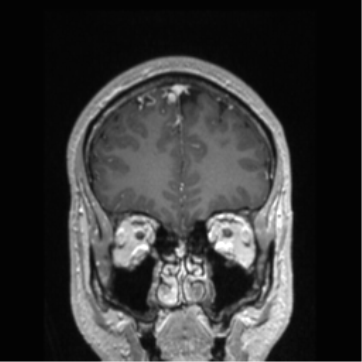 Cerebral arteriovenous malformation (Radiopaedia 39259-41506 Coronal T1 C+ 74).png