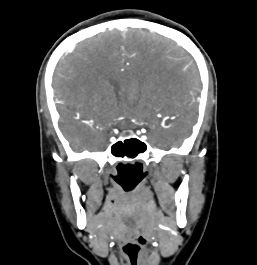 Cerebral arteriovenous malformation (Radiopaedia 73830-84645 C 41).jpg