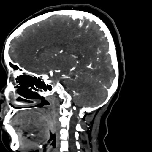 Cerebral arteriovenous malformation (Radiopaedia 73830-84645 Sagittal C+ delayed 54).jpg