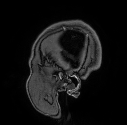 Cerebral arteriovenous malformation (Radiopaedia 74411-85654 Sagittal T1 C+ 1).jpg