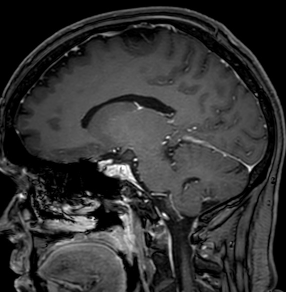 Cerebral arteriovenous malformation (Radiopaedia 74411-85746 Sagittal T1 C+ 54).jpg