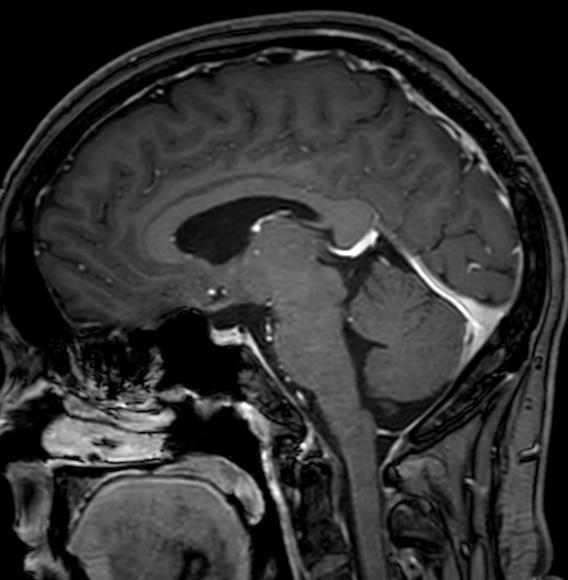 Cerebral arteriovenous malformation (Radiopaedia 74411-85746 Sagittal T1 C+ 61).jpg
