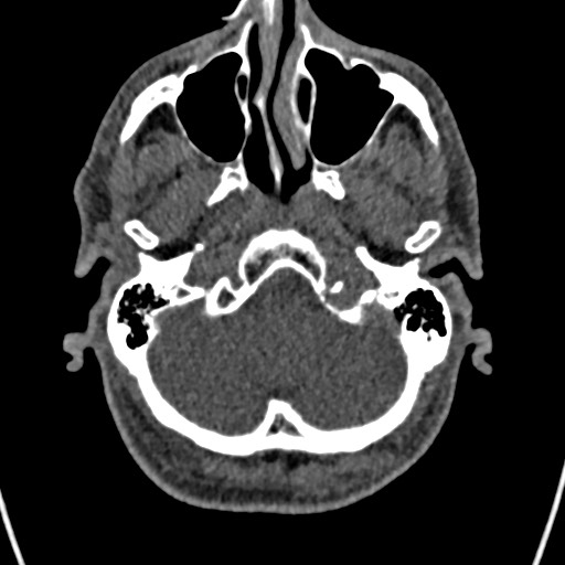 Cerebral arteriovenous malformation (Radiopaedia 78188-90746 Axial non-contrast 26).jpg