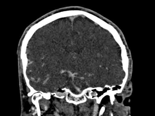 Cerebral arteriovenous malformation (Radiopaedia 78188-90746 Coronal C+ delayed 59).jpg