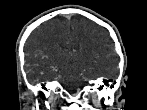 Cerebral arteriovenous malformation (Radiopaedia 78188-90746 Coronal C+ delayed 66).jpg