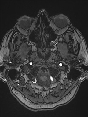 File:Cerebral arteriovenous malformation (Radiopaedia 84015-99245 Axial TOF 49).jpg