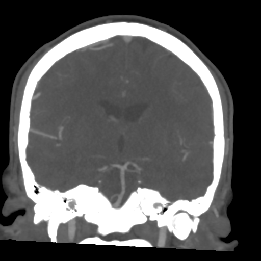 File:Cerebral arteriovenous malformation (Spetzler-Martin grade 2) (Radiopaedia 41262-44076 F 32).png