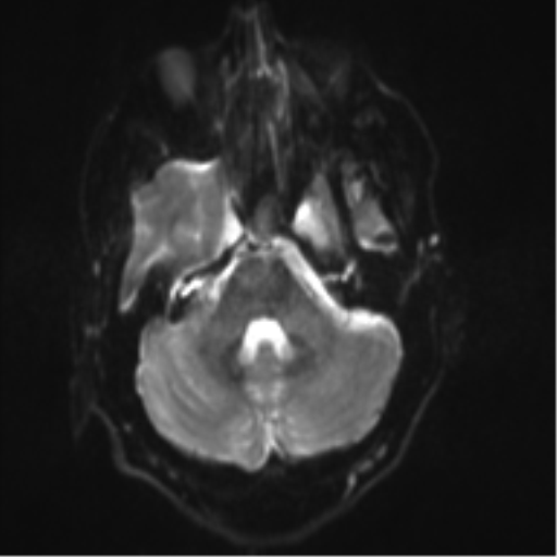 File:Cerebral arteriovenous malformation - huge (Radiopaedia 35734-37272 Axial DWI 6).png