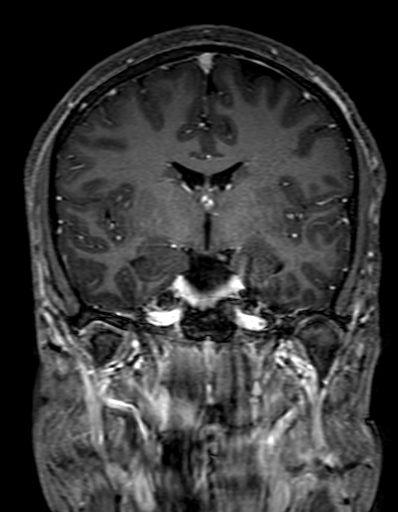 Cerebral arteriovenous malformation at posterior body of corpus callosum (Radiopaedia 74111-84925 K 169).jpg