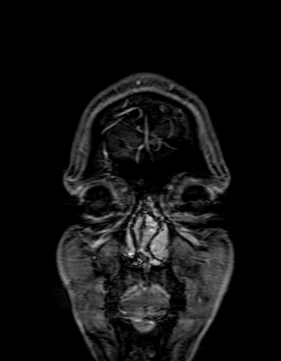 Cerebral arteriovenous malformation at posterior body of corpus callosum (Radiopaedia 74111-84925 K 8).jpg